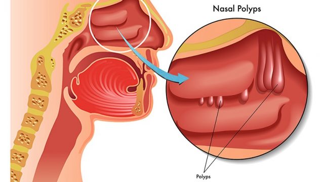 Nasal-Polyps-Konka